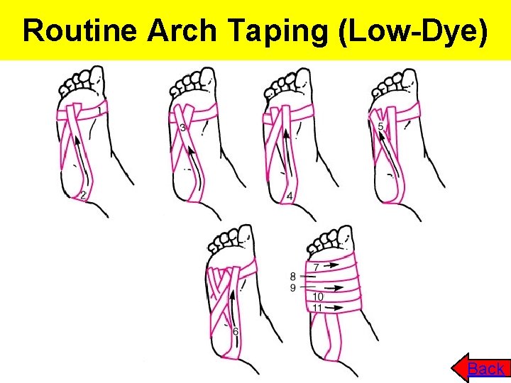 Routine Arch Taping (Low-Dye) Back Routine Arch Taping (Low-Dye) Back