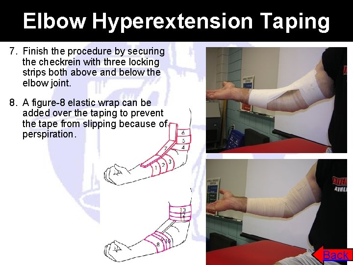 Elbow Hyperextension Taping 7. Finish the procedure by securing the checkrein with three locking