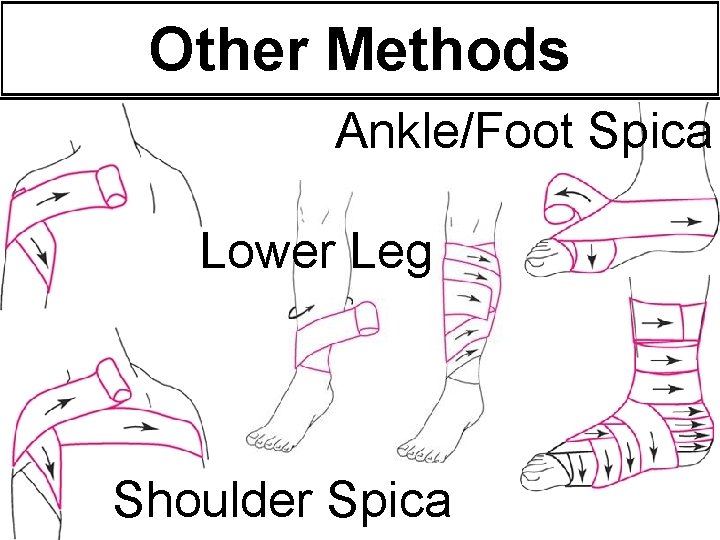 Other Methods Ankle/Foot Spica Lower Leg Shoulder Spica Other Methods Ankle/Foot Spica Lower Leg Shoulder Spica