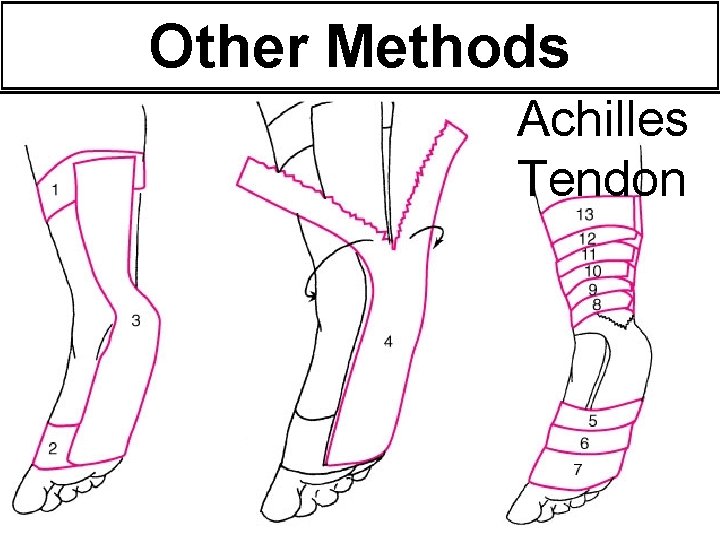 Other Methods Achilles Tendon Other Methods Achilles Tendon