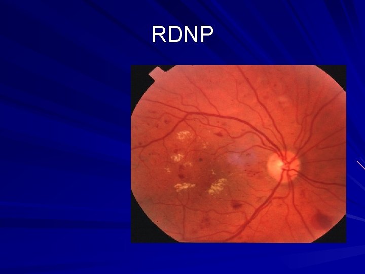RDNP 