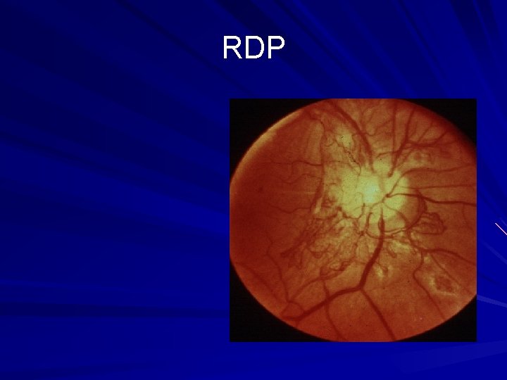 RDP 