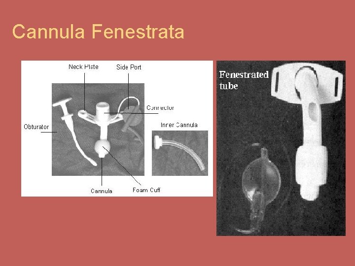 Cannula Fenestrata 