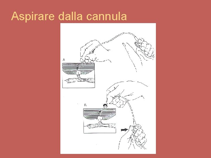 Aspirare dalla cannula 