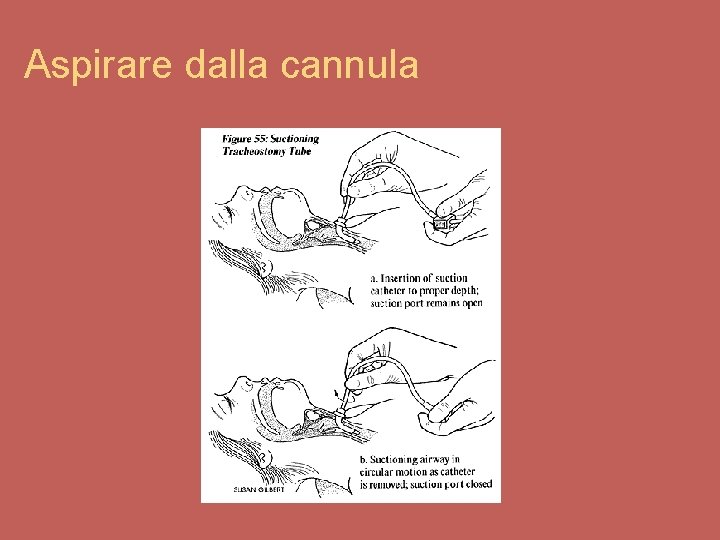 Aspirare dalla cannula 