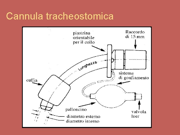 Cannula tracheostomica 