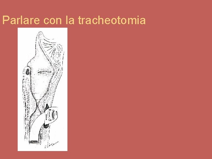 Parlare con la tracheotomia 