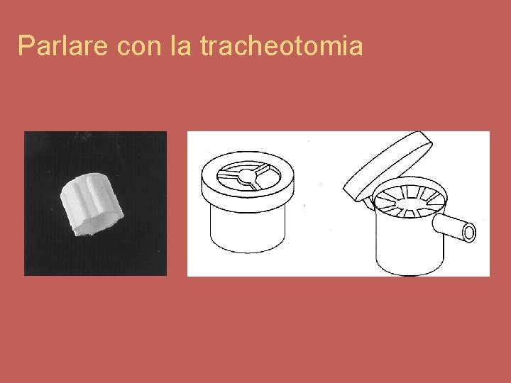 Parlare con la tracheotomia 