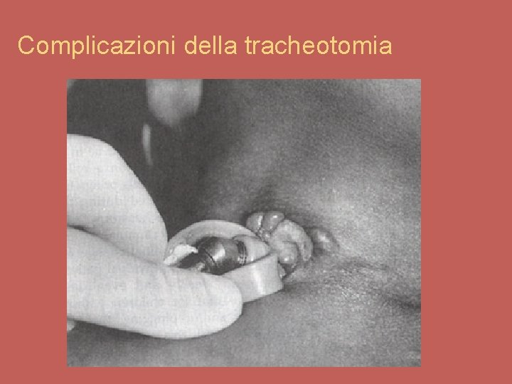 Complicazioni della tracheotomia 