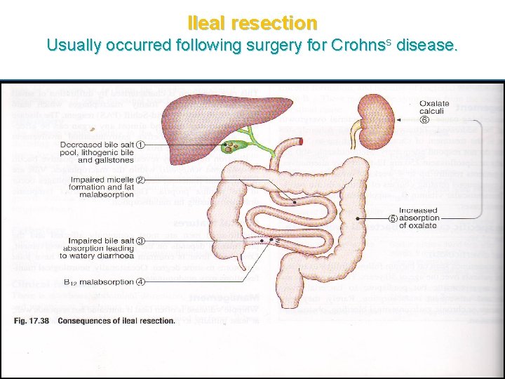 Ileal resection Usually occurred following surgery for Crohnss disease. 