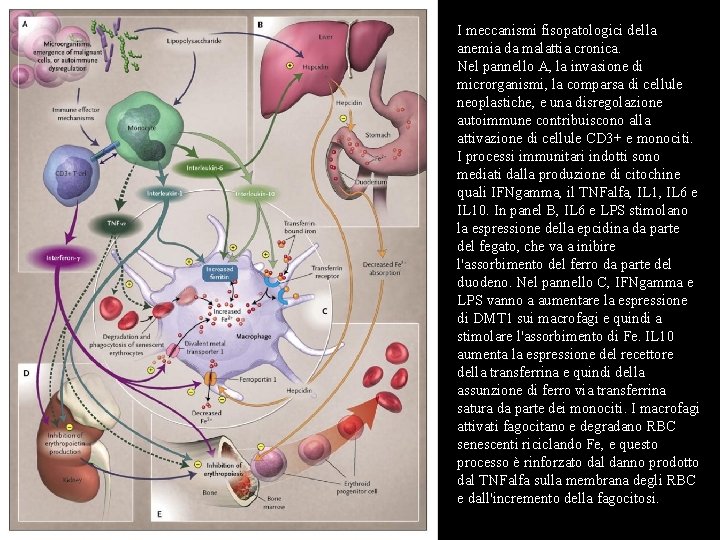 I meccanismi fisopatologici della anemia da malattia cronica. Nel pannello A, la invasione di