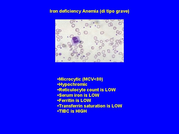 Iron deficiency Anemia (di tipo grave) §Microcytic (MCV<80) §Hypochromic §Reticulocyte count is LOW §Serum