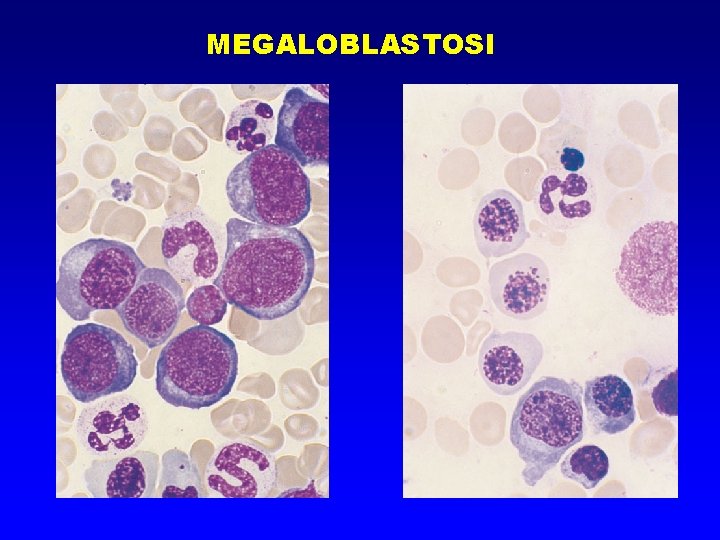 MEGALOBLASTOSI 