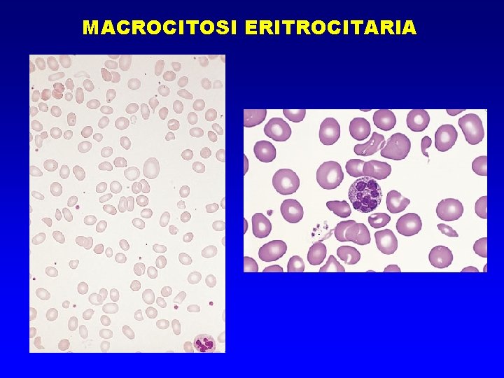 MACROCITOSI ERITROCITARIA 