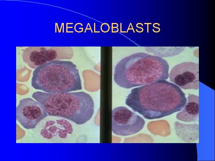 MEGALOBLASTS 