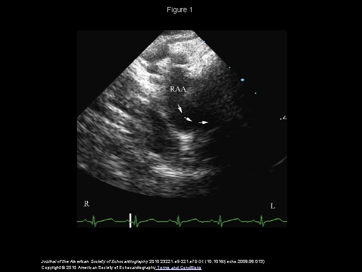 Figure 1 Journal of the American Society of Echocardiography 2010 23221. e 5 -221.