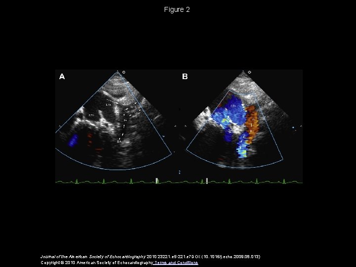 Figure 2 Journal of the American Society of Echocardiography 2010 23221. e 5 -221.