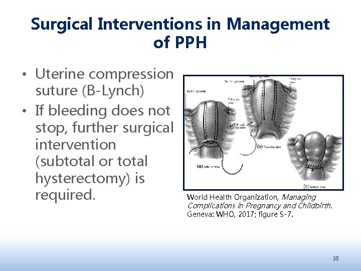 Surgical Interventions in Management of PPH • Uterine compression suture (B-Lynch) • If bleeding