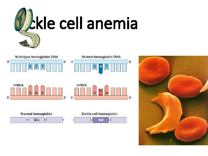 Sickle cell anemia 