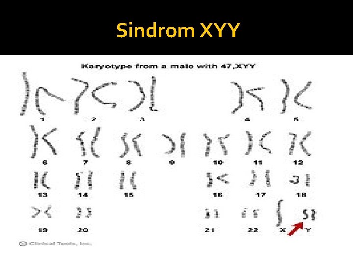 Sindrom XYY 