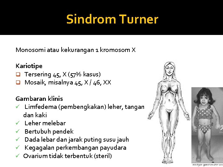 Sindrom Turner Monosomi atau kekurangan 1 kromosom X Kariotipe q Tersering 45, X (57%