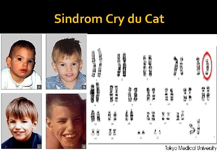 Sindrom Cry du Cat 