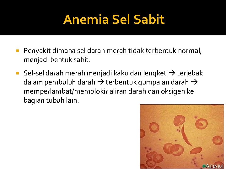 Anemia Sel Sabit Penyakit dimana sel darah merah tidak terbentuk normal, menjadi bentuk sabit.