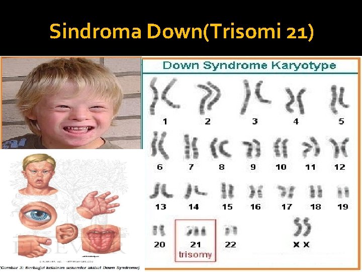 Sindroma Down(Trisomi 21) 