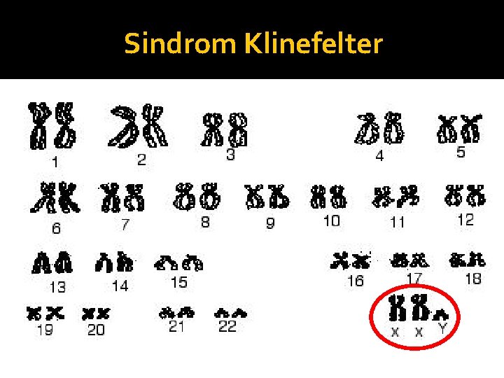 Sindrom Klinefelter 