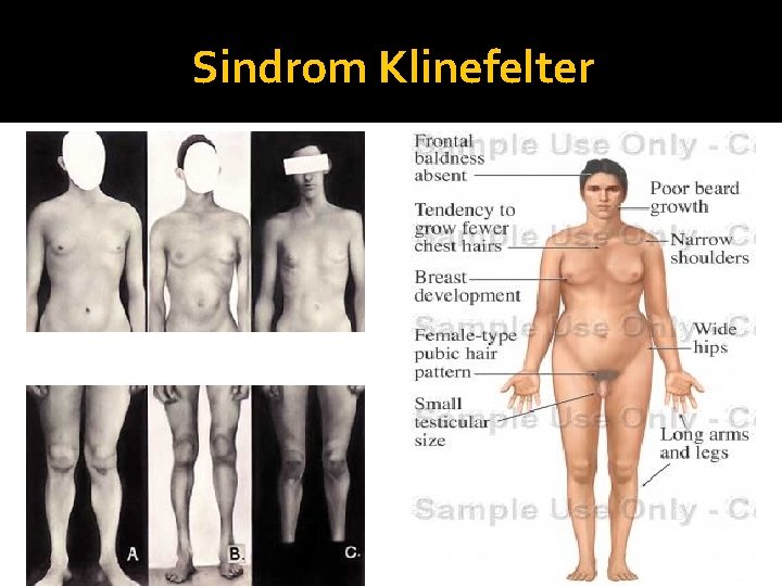 Sindrom Klinefelter 