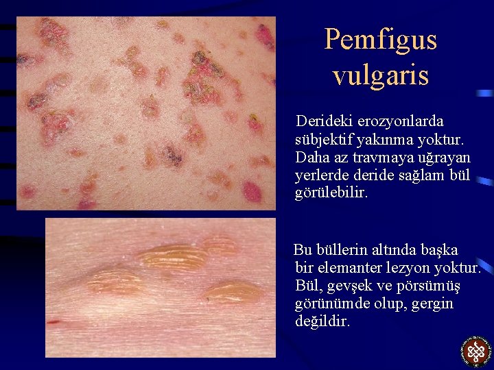 Pemfigus vulgaris Derideki erozyonlarda sübjektif yakınma yoktur. Daha az travmaya uğrayan yerlerde deride sağlam