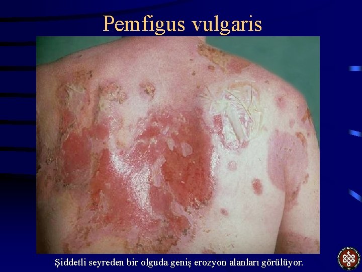 Pemfigus vulgaris Şiddetli seyreden bir olguda geniş erozyon alanları görülüyor. 