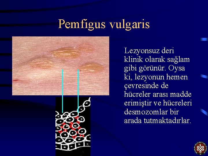 Pemfigus vulgaris Lezyonsuz deri klinik olarak sağlam gibi görünür. Oysa ki, lezyonun hemen çevresinde