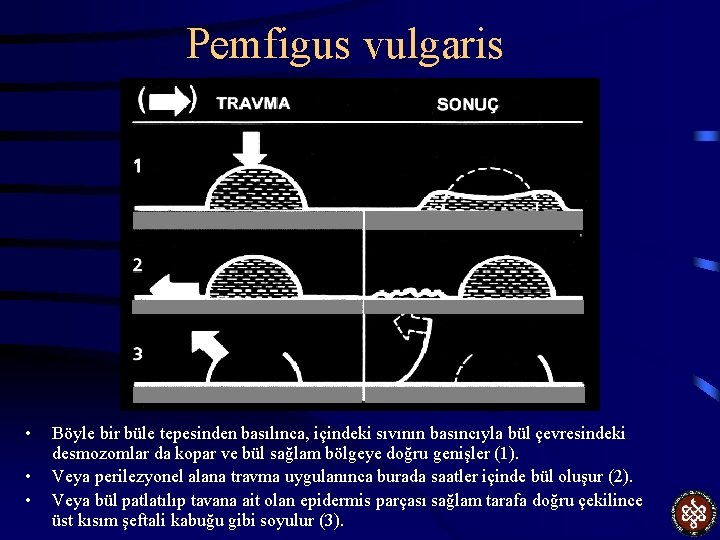 Pemfigus vulgaris • • • Böyle bir büle tepesinden basılınca, içindeki sıvının basıncıyla bül