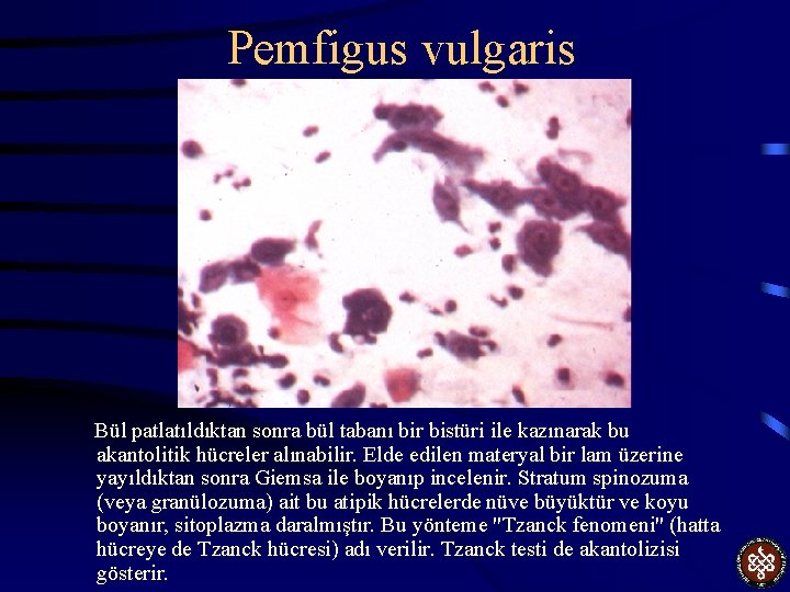 Pemfigus vulgaris Bül patlatıldıktan sonra bül tabanı bir bistüri ile kazınarak bu akantolitik hücreler