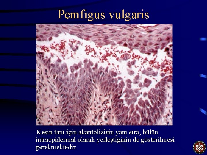 Pemfigus vulgaris Kesin tanı için akantolizisin yanı sıra, bülün intraepidermal olarak yerleştiğinin de gösterilmesi