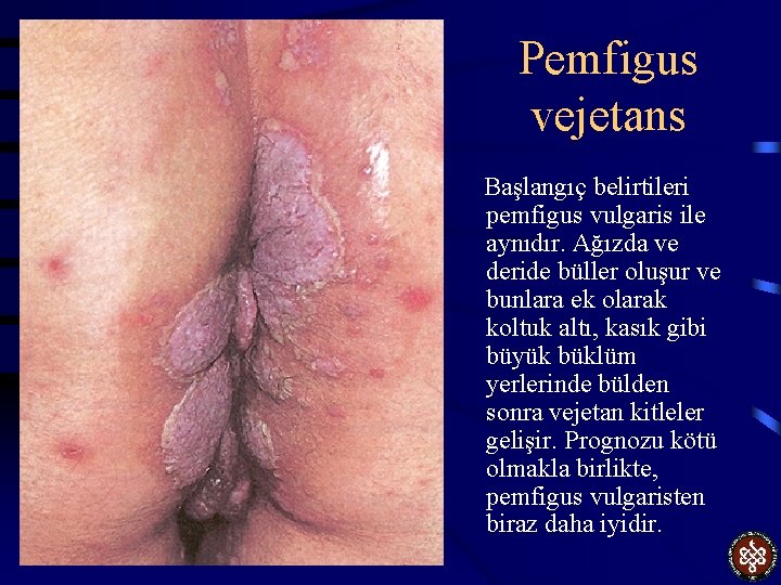 Pemfigus vejetans Başlangıç belirtileri pemfigus vulgaris ile aynıdır. Ağızda ve deride büller oluşur ve