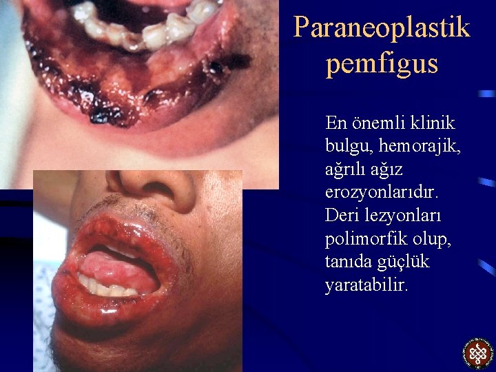 Paraneoplastik pemfigus En önemli klinik bulgu, hemorajik, ağrılı ağız erozyonlarıdır. Deri lezyonları polimorfik olup,