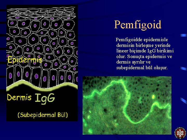 Pemfigoidde epidermisle dermisin birleşme yerinde lineer biçimde Ig. G birikimi olur. Sonuçta epidermis ve