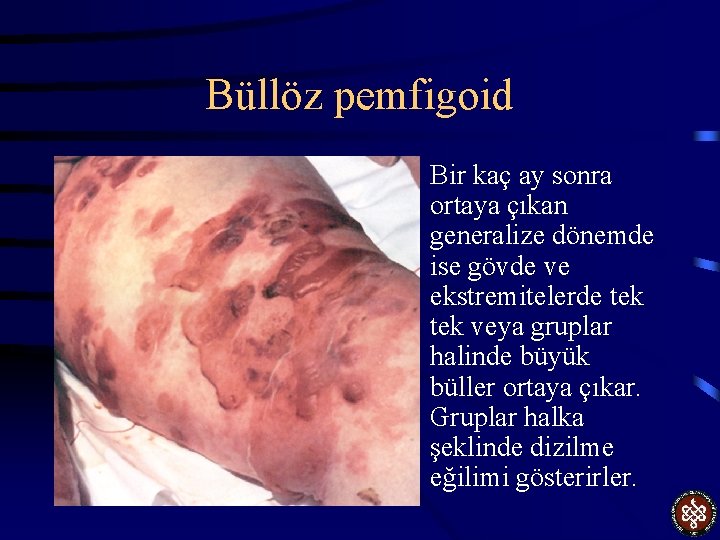 Büllöz pemfigoid • Bir kaç ay sonra ortaya çıkan generalize dönemde ise gövde ve