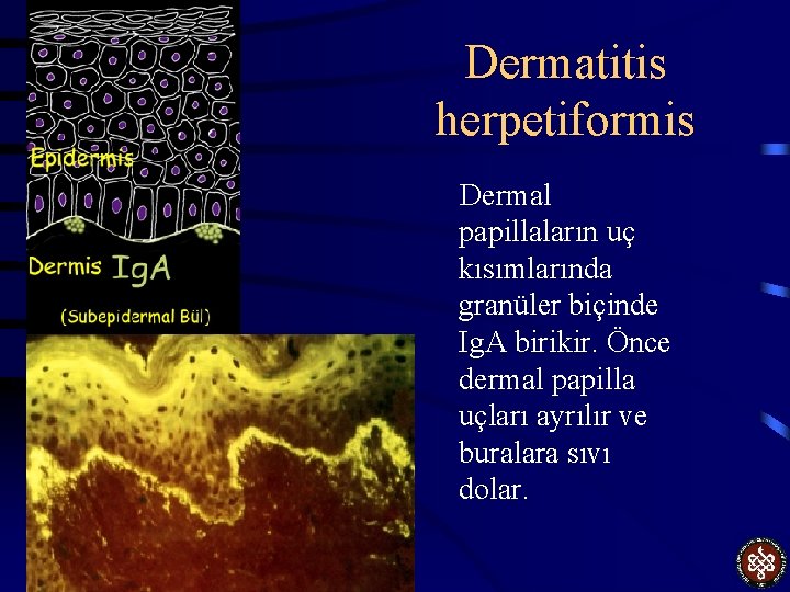 Dermatitis herpetiformis Dermal papillaların uç kısımlarında granüler biçinde Ig. A birikir. Önce dermal papilla