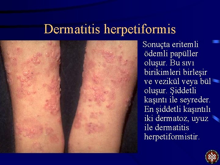 Dermatitis herpetiformis Sonuçta eritemli ödemli papüller oluşur. Bu sıvı birikimleri birleşir ve vezikül veya