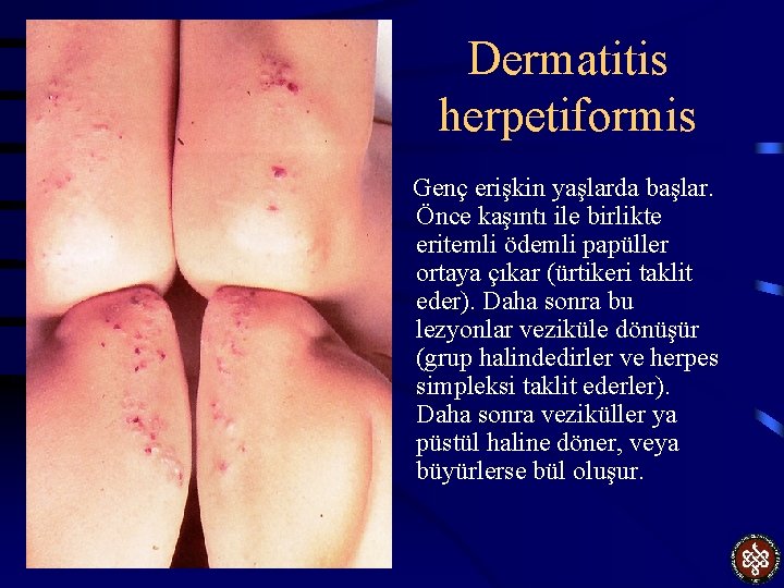 Dermatitis herpetiformis Genç erişkin yaşlarda başlar. Önce kaşıntı ile birlikte eritemli ödemli papüller ortaya