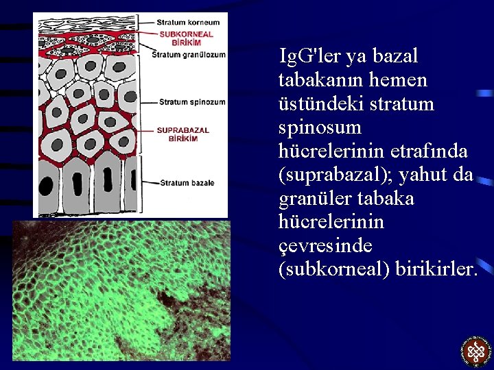 Ig. G'ler ya bazal tabakanın hemen üstündeki stratum spinosum hücrelerinin etrafında (suprabazal); yahut da