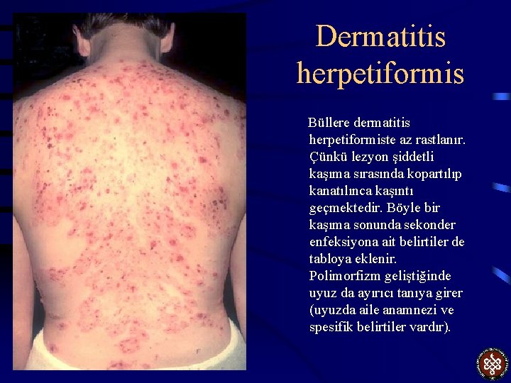 Dermatitis herpetiformis Büllere dermatitis herpetiformiste az rastlanır. Çünkü lezyon şiddetli kaşıma sırasında kopartılıp kanatılınca