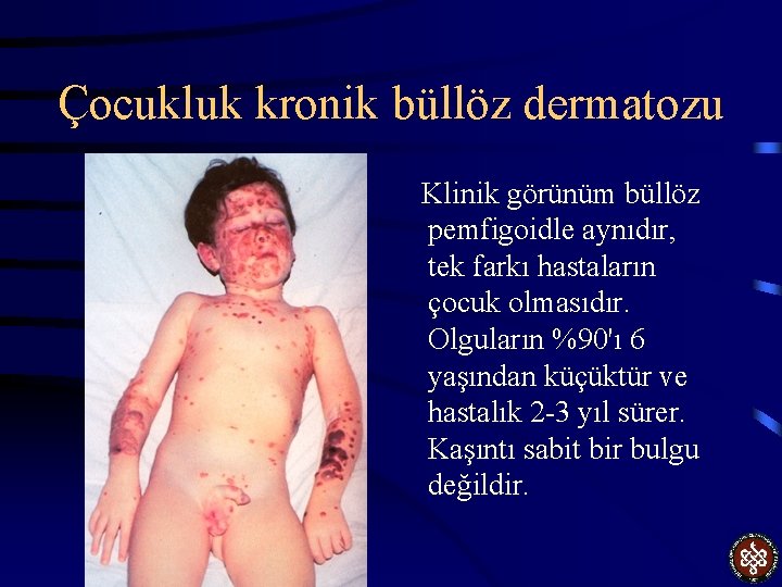 Çocukluk kronik büllöz dermatozu Klinik görünüm büllöz pemfigoidle aynıdır, tek farkı hastaların çocuk olmasıdır.