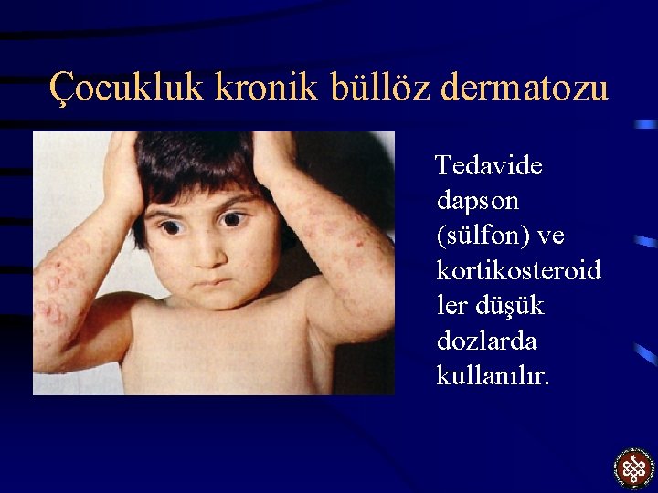 Çocukluk kronik büllöz dermatozu Tedavide dapson (sülfon) ve kortikosteroid ler düşük dozlarda kullanılır. 