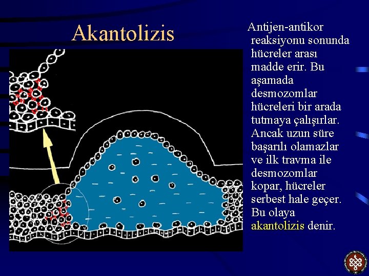 Akantolizis Antijen-antikor reaksiyonu sonunda hücreler arası madde erir. Bu aşamada desmozomlar hücreleri bir arada