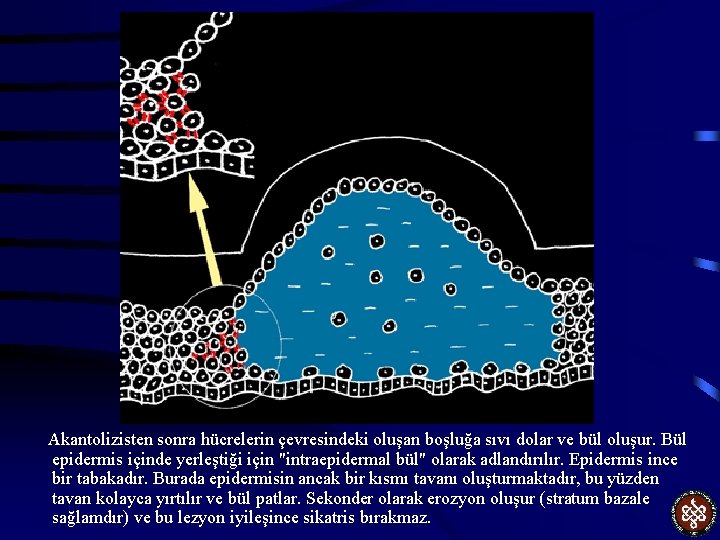 Akantolizisten sonra hücrelerin çevresindeki oluşan boşluğa sıvı dolar ve bül oluşur. Bül epidermis içinde