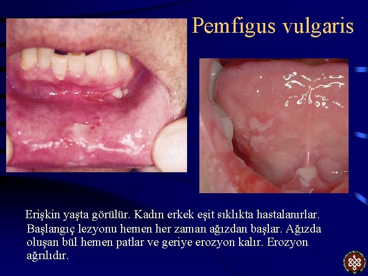 Pemfigus vulgaris Erişkin yaşta görülür. Kadın erkek eşit sıklıkta hastalanırlar. Başlangıç lezyonu hemen her